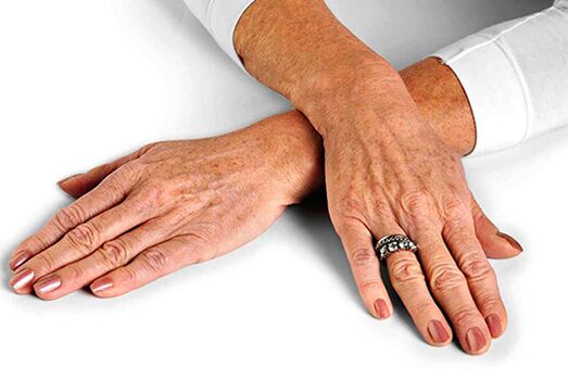 Hand skin with age-related changes that require the use of rejuvenation technology
