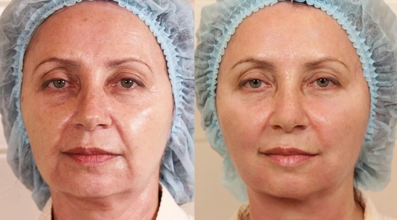 before and after photos of facelifts