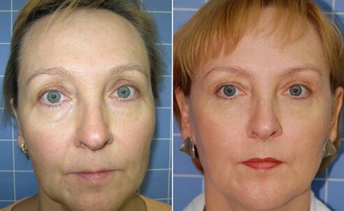 Before and after fracture change of facial facial changes