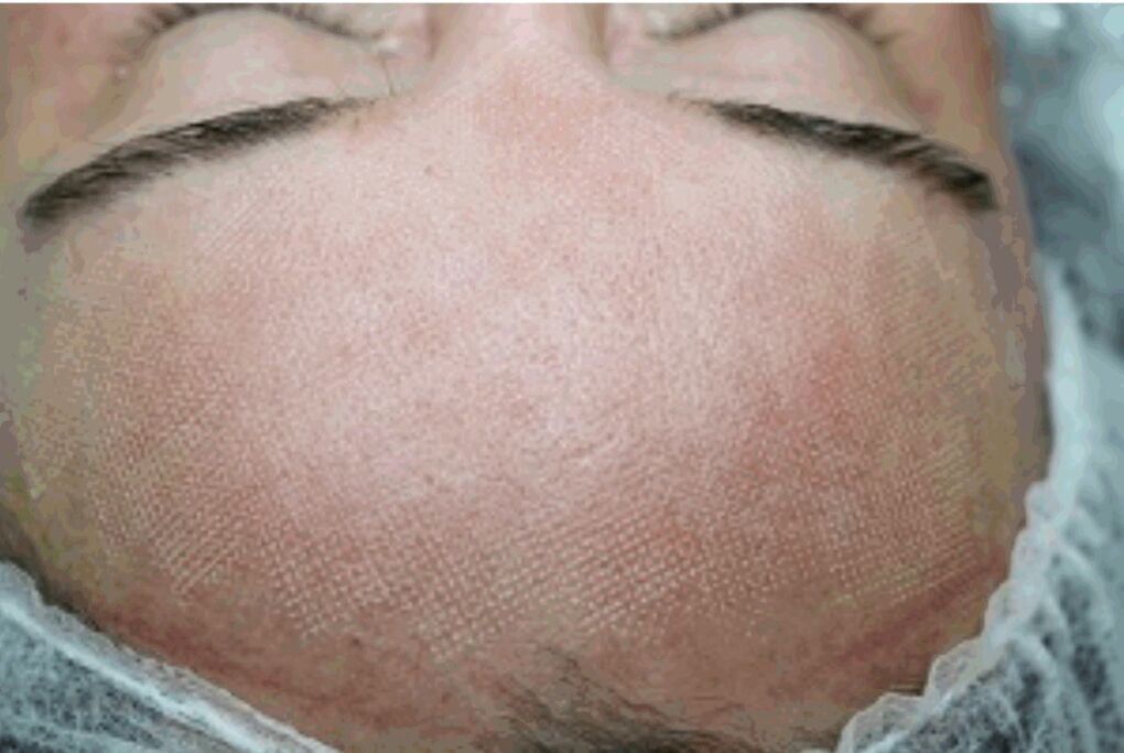 Redness and slight inflammation of the skin after laser fracture